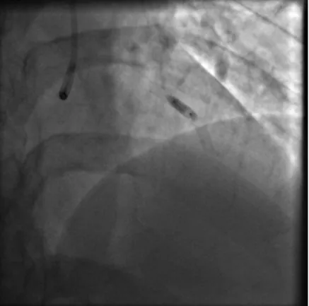 Figura    6  –  Entrega  intracoronária  de  CMNMO  com  a  técnica  de  stop  flow  num  doente com enfarte agudo do  miocárdio