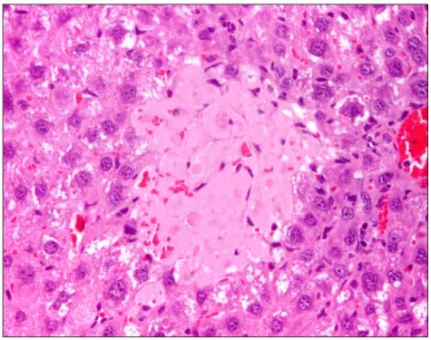 Figura 10 Área de necrose (H&amp;E, 400x). 