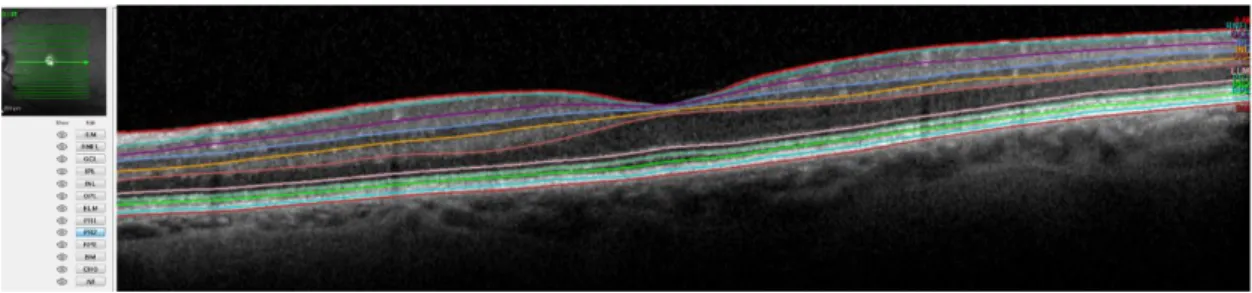 Figura 2 - Segmentação das camadas retinianas. 