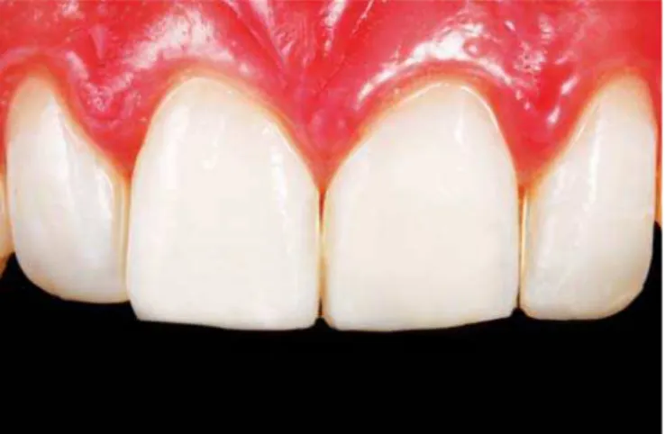 Fig. 4: Insertion of dentin resin, body, incisal effect, opaque resin and characterization of white