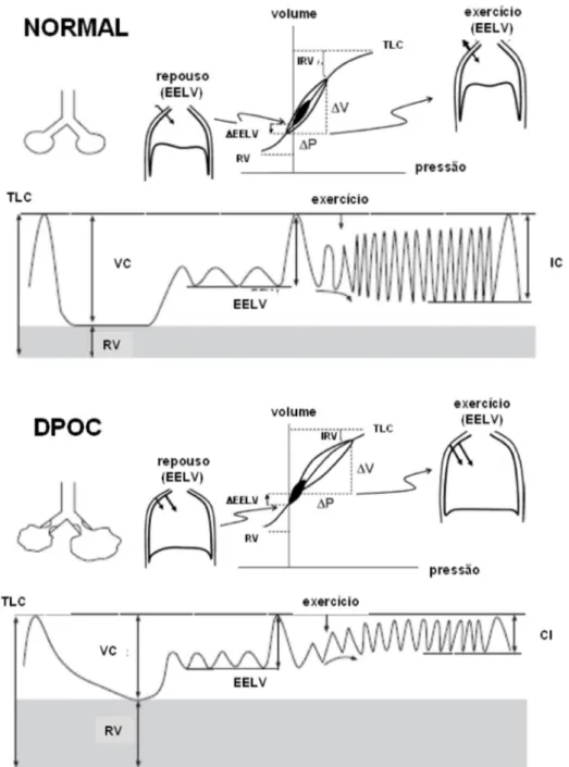 Figura 2.1 – Diferenças de volume e pressão na ventilação de repouso e  esforço entre saudáveis e DPOC ( adaptado de O'Donnell, D.E