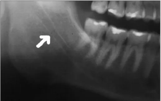 Figura 2 - Aspecto radiográfico do canal mandibular  2   