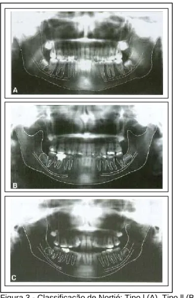 Figura 3 - Classificação de Nortjé: Tipo l (A), Tipo ll (B), Tipo lll (C)  3