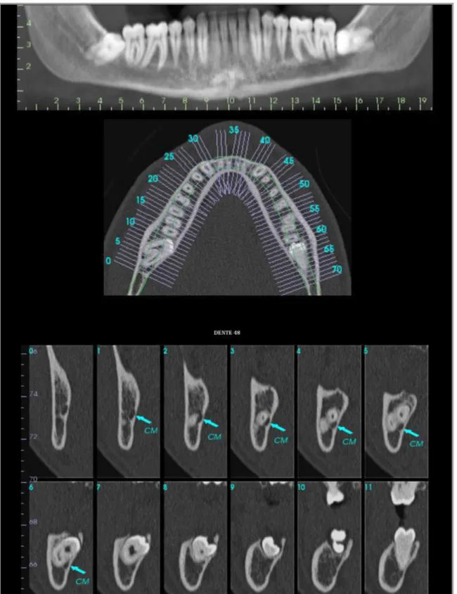 Figura 13 - TC mostrando a íntima relação entre o dente 48 e o CM 19