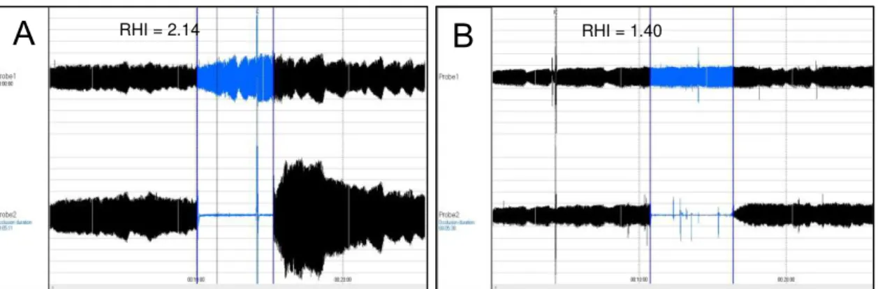 Figure  19  -  Examples  of  peripheral  endothelial  function  measured  by  digital pulse  amplitude  with endothelial peripheral arterial tonometry 