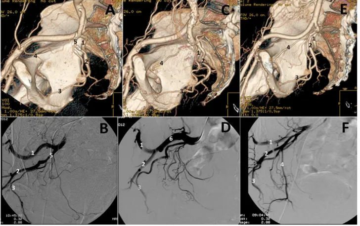 Figure 1 - Branching patterns of the internal iliac artery. 