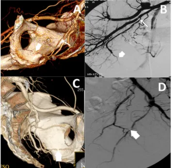 Figure 4 - Examples of lesions found on the internal iliac arteries.