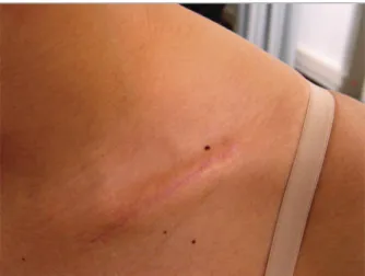 fIguRe 5. Photograph of the surgical incision 4 months after surgery.  
