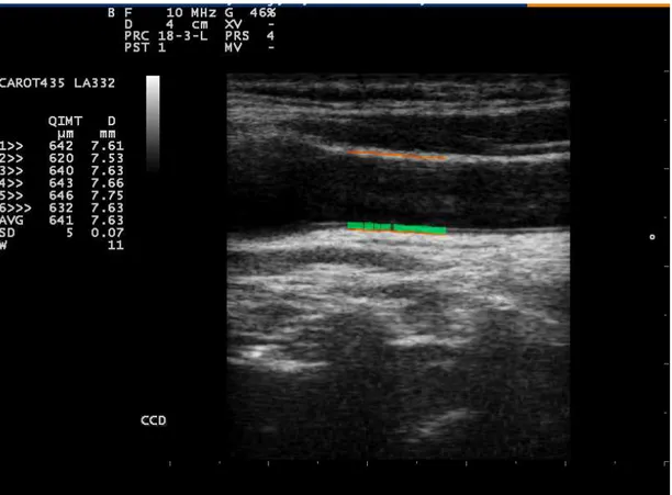 Figure 1. Measurement of intima-media thickness of the common carotid artery   using radiofrequency