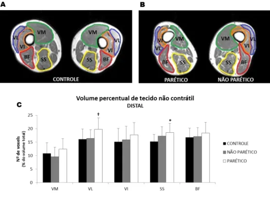 Figura  3.  Volume  percentual  de  tecido  não  contrátil  do  quadríceps  e  isquitibiais  no  terço  distal  da  coxa