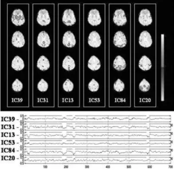 Fig. 1. Five thresholded IC maps (alternative hypothesis test at p &gt; 0.5) are shown with their corresponding timecourses  under-neath.Four absence seizures are indicated with gray shading.