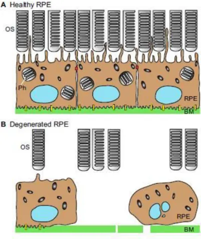 Figure 1.15 : Healthy and degenerated RPE: implications for retina’s overall structure.