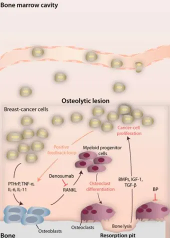 Figure 1 - Interactions between bone and cancer cells  in  predominantly  osteolytic  breast  cancer  lesions