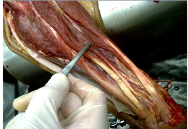 Figure  3  –  Muscular  bridging  expansion.  Muscular  bridging  ex- ex-pansion between the main muscular shafts of the Extensor Digiti  Minimi and the Extensor Digitorum Communis Muscles, in the right  forearm of a 73 year old male caucasian cadaver
