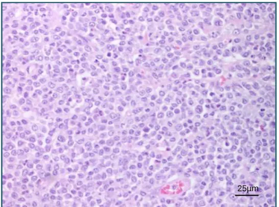 Figura 6. Aspeto microscópico de um mastocitoma cutâneo canino de grau 3. HE. Estalão=25µm