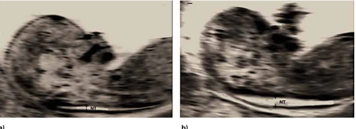 Figura 3. a) Espessura normal da TN; b) Espessura aumentada da TN  (Adaptado de (158)) 