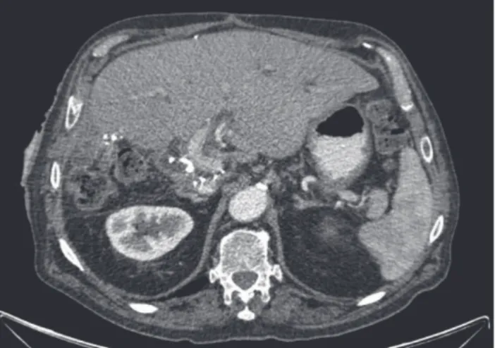 Figure 2 – Computed tomography scan showing the presence of  metallic suture staples of hepaticojejunostomy