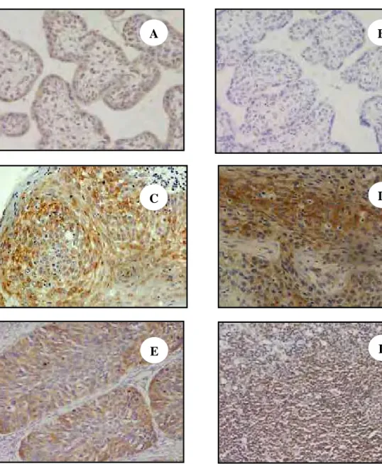 Figura 9. Reação de imunoperoxidase para HLA-E com marcação castanha no  citoplasma em lesões de laringe