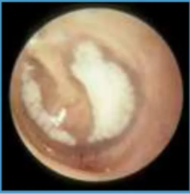 Figura 1.1:  Otoendoscopia do ouvido esquerdo com miringosclerose. 