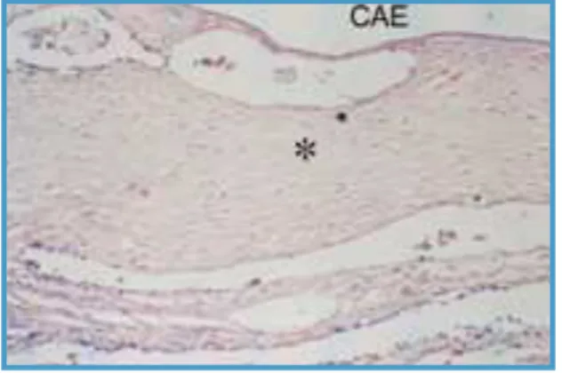 Figura 1.2: Secção Axial da membrana timpânica com miringosclerose corada  com hematoxilina-eosina