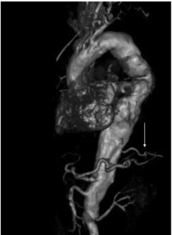 Figure 2 - Stent graft excludes aneurysm of the thoracic aorta Figure 3 - Preoperative angio-CT scan with intercostal artery