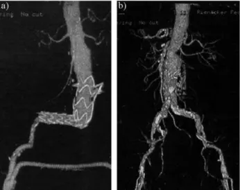 Figure 5 - Increased landing zone after aorto-hepatic bypass to permit overstenting of the celiac trunk