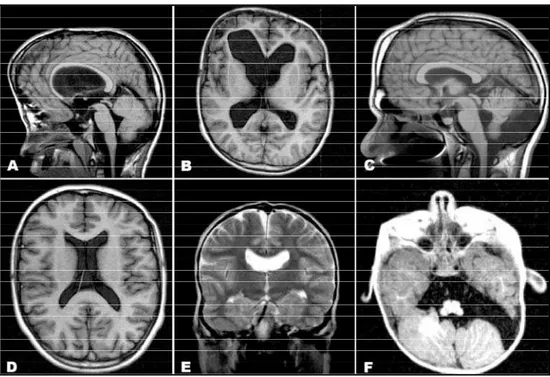 Fig 1. Ventriculomegaly and corpus callosum hypoplasia - MRI in sagital plane and T1 acquisition (A) and axial plane and T1-IR acquisition (B)