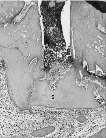 FIGURE 1 - Group I (Se a la pex) – bio lo gi cal se a ling of the apex with mi ne ra li zed tis sue de po si ti on (S)