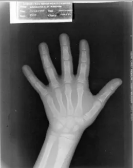 Figura 11 – Radiografia de mão e punho de indivíduo do sexo masculino, com  idade cronológica de 9,42 anos