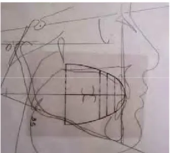 Figura 22 - Diagrama de Andrade em que houve coincidência do ponto J com os  incisivos inferiores, indicando bom posicionamento destes