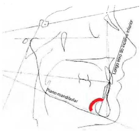 Figura 24 - Ângulo formado pelo plano mandibular com o longo eixo do incisivo central  inferior (IMPA)