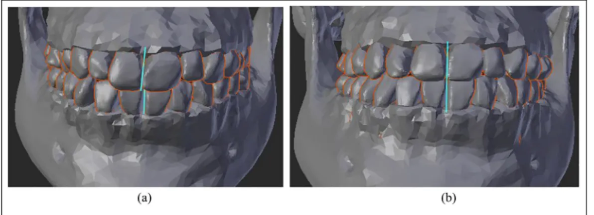 Figure 4. Representation of the right sagittal view: (a) before dental correction and (b) after dental correction and resolution of malocclusion class II.