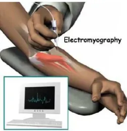 Figura 1.2 – Recolha de sinal EMG utilizando el´etrodos de agulha (Gupta et al., 2012).