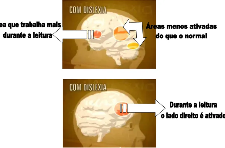 Figura 5 - Funcionamento do hemisfério esquerdo do cérebro de uma pessoa com Dislexia durante a leitura