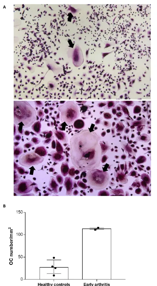 Figure  4  -  TRAP  staining  of  in  vitro  differentiated  osteoclasts.  A:  representative  image  of  OCs  of  healthy  controls (top) and early arthritis patients (bottom) (10× magnification) at culture day 21, stained for TRAP