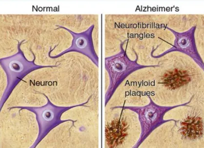 Figure 7. Representation of Alzheimer’s pathologic features. Retrieved from BrightFocus  Fundation