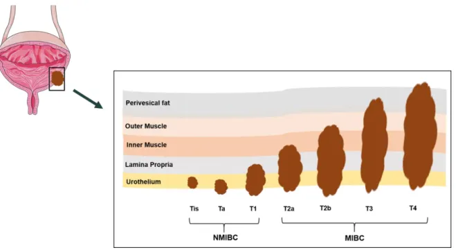 Figure  2.  Bladder  cancer  staging.  Urothelial  cell  carcinoma  can  be  divided  in  2  subtypes,  non- non-muscle invasive bladder cancer (NMIBC) and non-muscle-invasive bladder cancer (MIBC)
