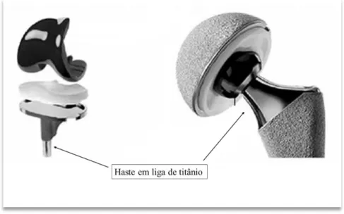 Figura 1 – Exemplo de próteses do joelho, à esquerda, e da anca, à direita (Bombac et al., 2007)