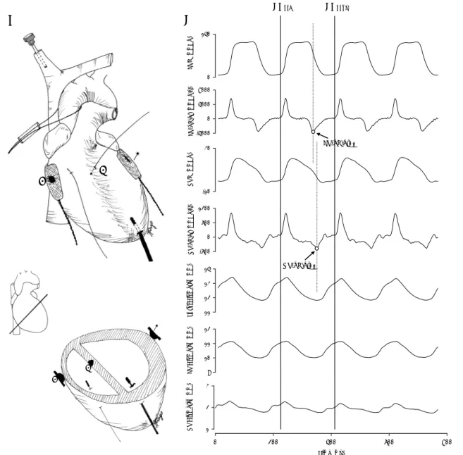 Fig. 1. A. Schematic representation of experimental heart instrumentation of both ventricles