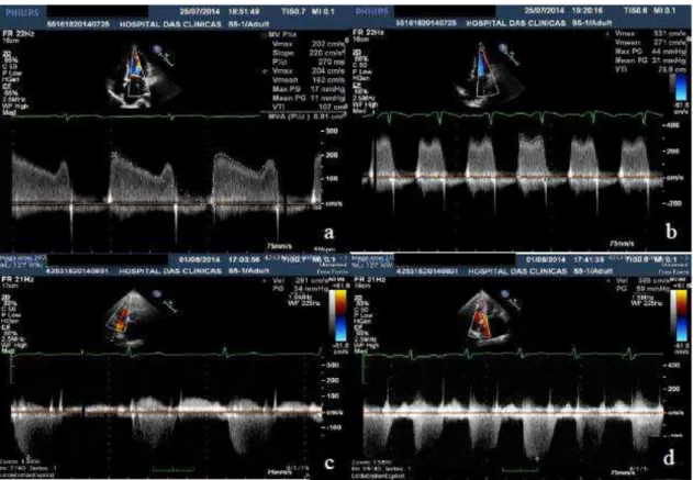 Figure  2:  Exercise  echocardiography  of  a  patient  at  baseline  (on  the  left)  showing an increase in transmitral pressure gradientes and tricuspid regurgitant  peak velocity at exercise peak (on the rigth)