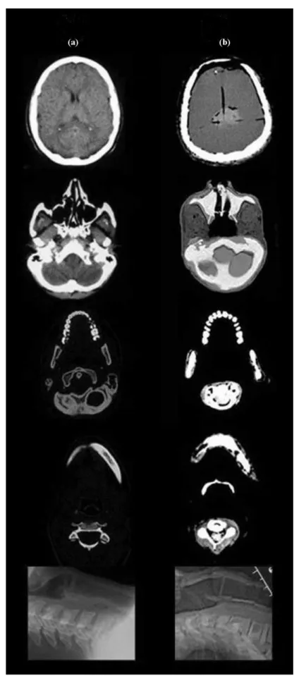 Figura 4 – Resposta radiológica (TC) da (a) cabeça e pescoço humano (TOSHIBA LEADING INNOVATION, 2010) e (b) phantom: crânio e vértebras, cérebro, faringe e laringe.