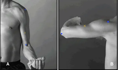 Figura 10. Posicão de colocação de eletrodos (marcação em “x”):   (A) Músculo bíceps braquial; (B) Músculo tríceps braquial – cabeça lateral