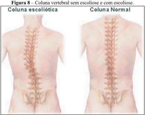 Figura 8 – Coluna vertebral sem escoliose e com escoliose. 