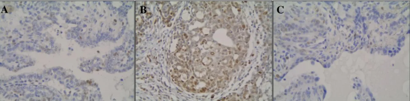 Figura 5: Expressividade do Ki-67 (400x) em três tipos de lesões; A: papilar; B: cribriforme; C: cistopapilar