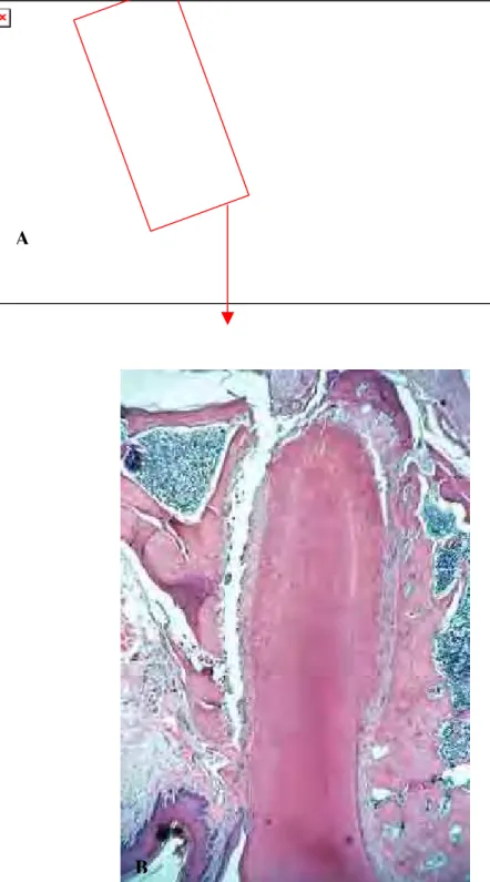 Figura 10: A) Desenho esquemático da área analisada. B)  Raiz mesial com rompimento do  ligamento periodontal em toda sua extensão e fratura da crista alveolar