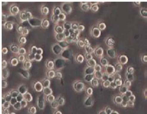 Figura  4:  Células  tipo  linfoblasto. 
