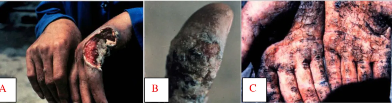 Figura  1.2  –   Lesões  cancerígenas:  A,  B,  C  –   Câncer  de  pele  (queratose)  causado  pelo  contato  dermal  e 