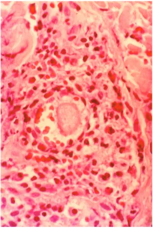 Fig. 5 - Larva migrans – a rich in eosinophils, chronic inflammatory process, with epidermic hyperplasia, fibrosis, hypervascularization, and edema in the dermis