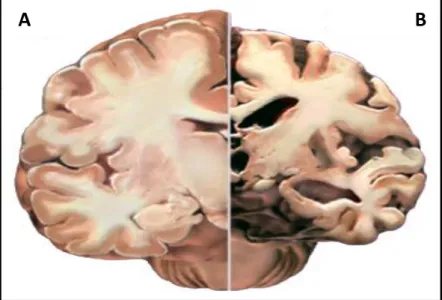 Figura 1.1 Comparação entre o cérebro de um indivíduo saudável (A) e  o  cérebro  de  um  doente  de  Alzheimer  (B)