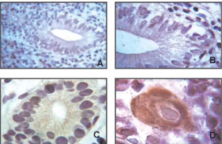 Fig. 2 - Immunohistochemical staining with monoclonal antibody for CMV in enteric tissue of UC patients